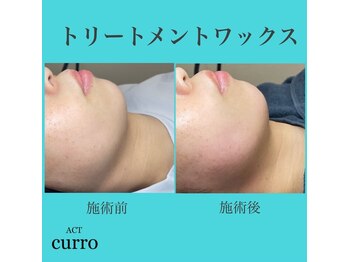 アクト クロ(ACT curro)/【フェイシャル】施術例