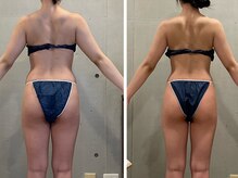 エクセレントビューティーサロン 艶(EN)/VENUS DIVA１回