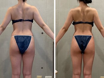 エクセレントビューティーサロン 艶(EN)/VENUS DIVA１回