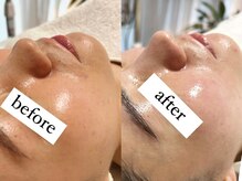 エクレ(eclat)/《美白ケア》白玉ピーリング