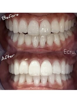 エクリュ(Ecru)/驚愕の白さ！医療提携ジェル★