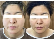 ルポ 那覇(repos)/電気美容鍼