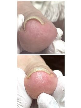 巻き爪フットケアサロン 神楽坂/アクリル×プレート巻き爪ケア