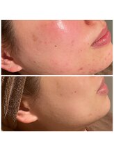 フォルチェ はません店(Folche)/頑固なニキビ・色むらに