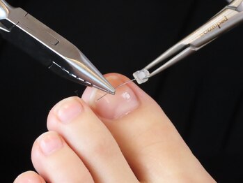 ドクターネイル爪革命 札幌本店/メニュー7 巻き爪ケア