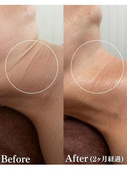 フェミューズアカサカ(FEMUSE AKASAKA)/コラーゲンマシン