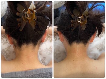 アプロディタ/うなじ脱毛で印象爆上がり