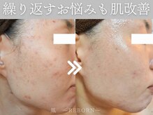 年を追うごとに気になるシワ・たるみ・毛穴などお任せください！