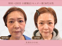満足度の高い小顔矯正をご提供☆美整小顔を作り上げます！/横浜
