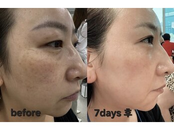 リュクシー(LuxeY)/インセルダム7日間使用