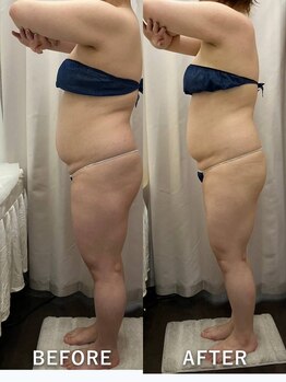 ベルミーランド MEGAドン・キホーテ草加/痩身BeforeAfter