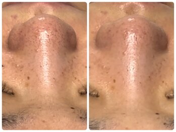 ベルドア(Bell Door)/1回トリートメント