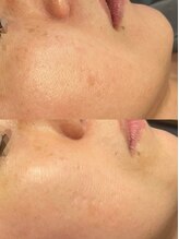 モルセラ(Moluccella)/10回の施術