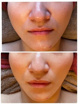 アナベル(ANNABELLE)/ハーブピーリング2倍量塗布