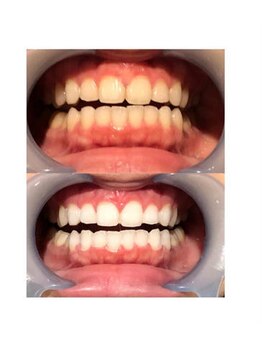 シャルム(CHARMER)/激安！プレミアムホワイトニング