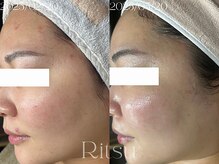 リツ(Ritsu)/繰り返すニキビケア