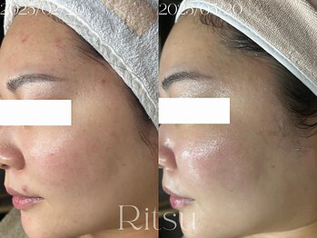 リツ(Ritsu)/繰り返すニキビケア