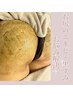 県内希少【お尻ニキビ・黒ずみ・ブツブツケア】剥離ハーブピーリング¥99,000