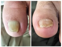 フレッシュフット(FreshFoot)/どんな巻き爪も対応★