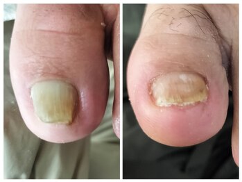 フレッシュフット(FreshFoot)/どんな巻き爪も対応★