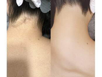 エピ リブレ(8epi.Libre)/うなじ　合計12回1.5カ月に1回