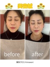鍼灸サロン ヒマワリ(himawari)/美容鍼before⇒after