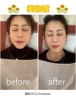 鍼灸サロン ヒマワリ(himawari)/美容鍼before⇒after