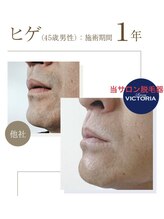 エムズスタイル ネイルバー(M's Style NAIL BAR)/髭脱毛