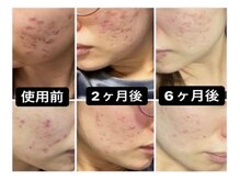 ナチュラーレ 梅田店(Naturale)/美肌ニキビケア小顔フェイシャル
