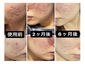 ナチュラーレ 梅田店(Naturale)/美肌ニキビケア小顔フェイシャル