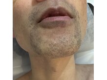 ロイビー(loeyB)/脱毛開始して３ヶ月