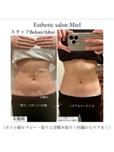 ミエル 神戸店(Miel)/腸オイルセラピーでくびれ作り