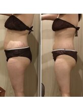 カンフリエ 吉野ヶ里店(Camphrier)/【痩身】ビフォーアフターご紹介