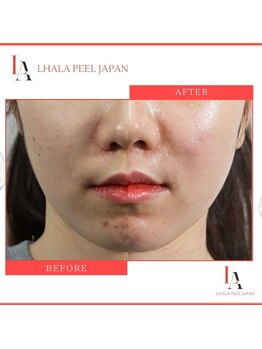 アリアンド(ari.and)/ララピール　症例写真