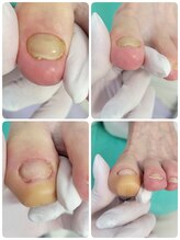 巻き爪補正店 西宮北口店/変形爪