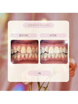プラスビー 2号店(+b)/ホワイトニングビフォーアフター