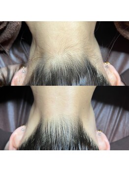 ゴールデンエイジ 吉祥寺(GOLDEN AGE)/ワックス脱毛 : 施術