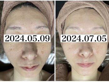 ホワイトアクア 岐阜店(WHITE AQUA)/ララピール/岐阜/ニキビ