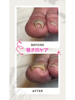 ドクターネイル爪革命 恵庭店/巻き爪ケア