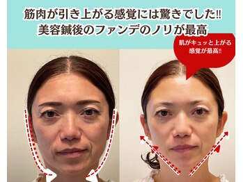 ピュアハリ/沖縄美容鍼 効果