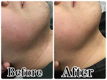 ルリアン(LeLien)/髭脱毛　施術7回の効果！！