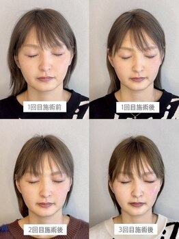 小顔矯正&美容整体サロン Still U 渋谷/3回の変化♪