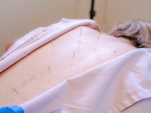 ビランシア(BILANCIA)/鍼灸