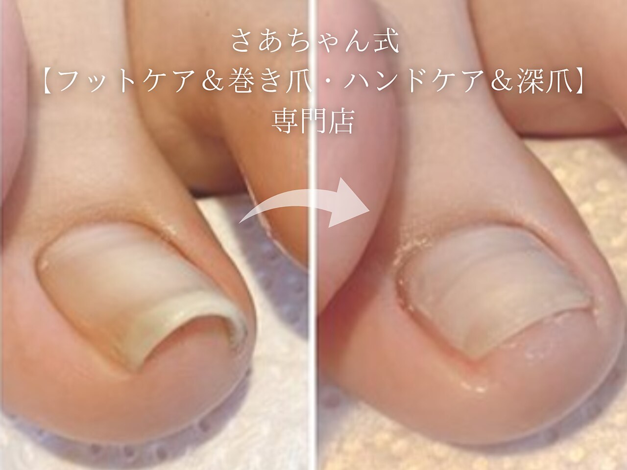 さあちゃん式フットケア アンド 巻き爪 ハンドケア アンド 深爪専門店