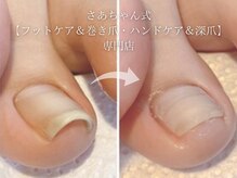 さあちゃん式フットケア アンド 巻き爪 ハンドケア アンド 深爪専門店