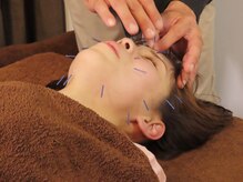 鍼灸オオクニ多肥(鍼灸okuni多肥)/美容鍼後の変化をお試しください