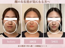 フラン(franc)/歪みでお悩みの方へ