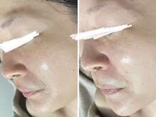 ホワイトアクア 岐阜店(WHITE AQUA)/ララピール/岐阜/ニキビ