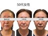 【 たるみ特化／頬コケなし 】サーマガン全顔500ショット！ 60分