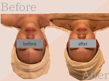 ファミーユ 名古屋店/【吸引後ケア、ダウンタイム】